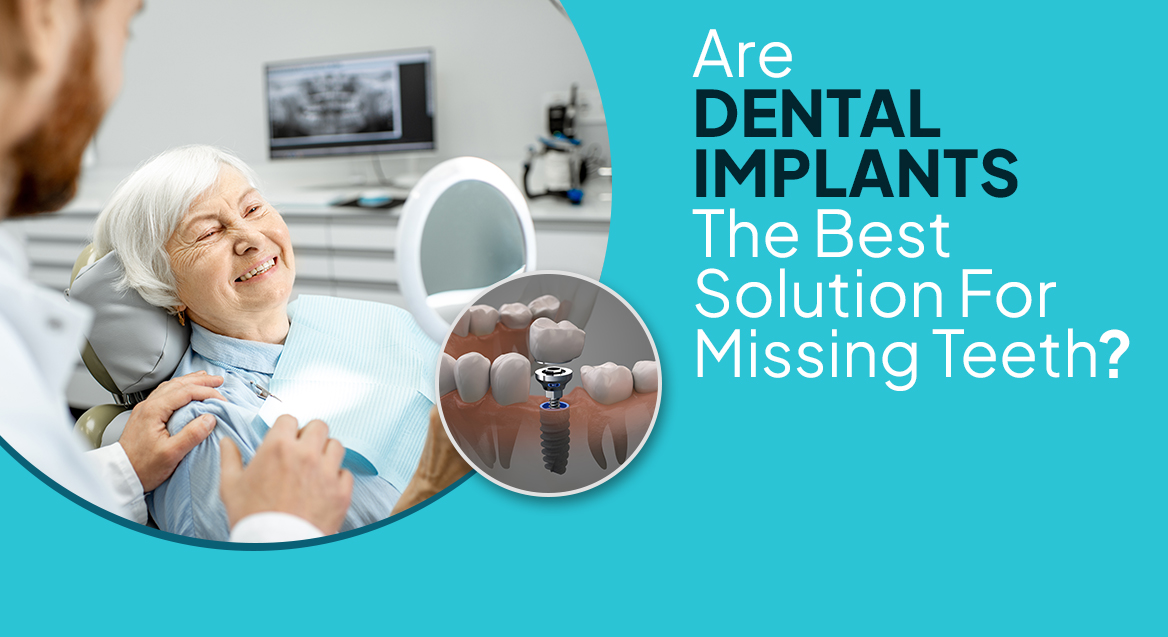 Are Dental Implants The Best Solution For Missing Teeth?